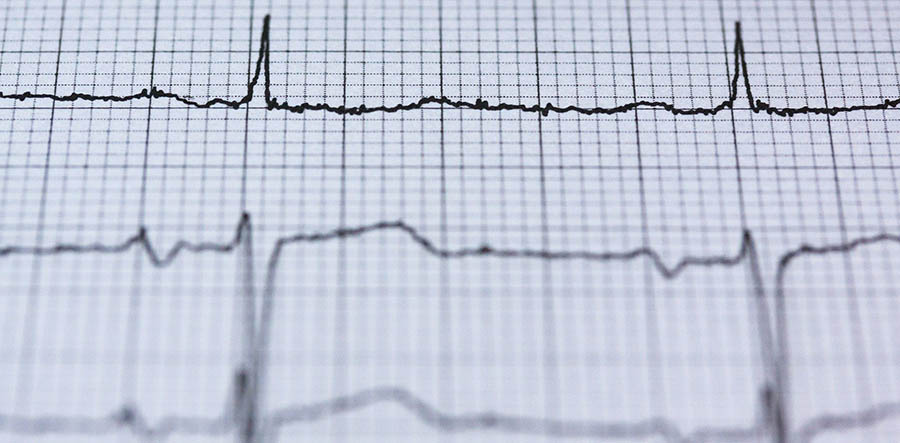 heart monitoring chart